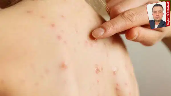 Birlik ve Dayanışma Sendikası Genel Başkanı Dr. Mehlepçi’den artan kızamık vakalarına ilişkin sembolik adım çağrısı: ‘Cumhurbaşkanının torununu aşı yaptırdığı görüntüler yayımlansa, karşıtlık en az yüzde 50 azalır’