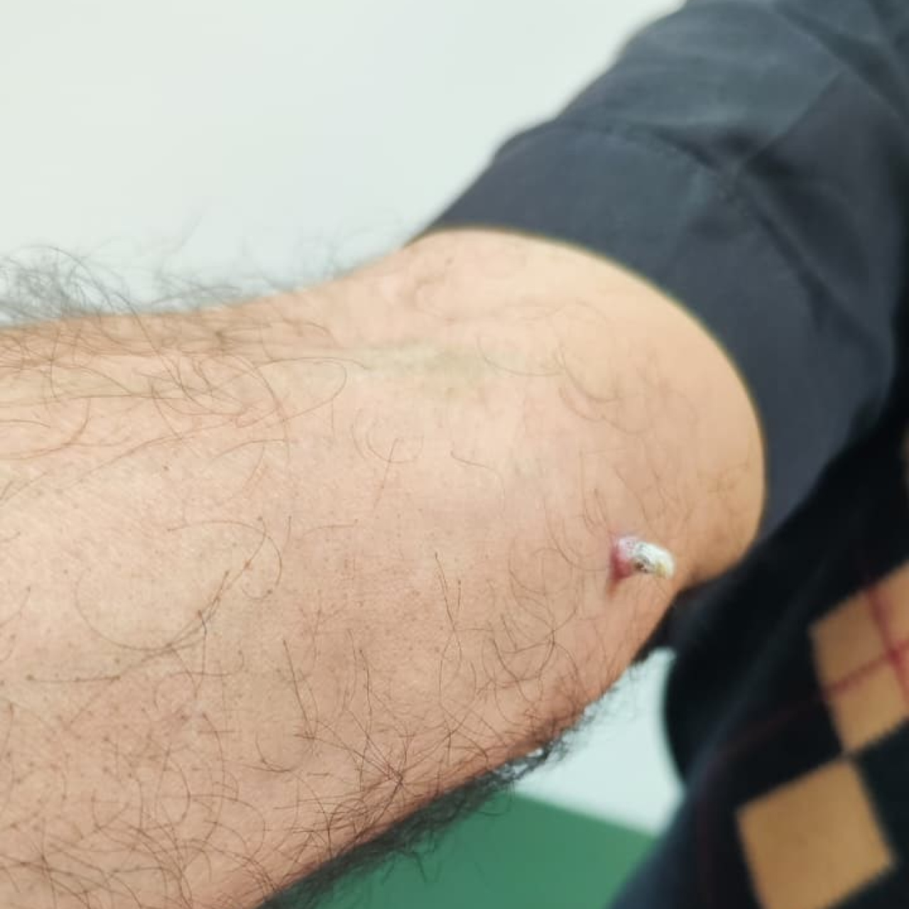 İstanbul'da yaşayan 75 yaşındaki İbrahim Çelik, kolunda çıkan yara geçmeyince Ümraniye Eğitim ve Araştırma Hastanesi'ne başvu