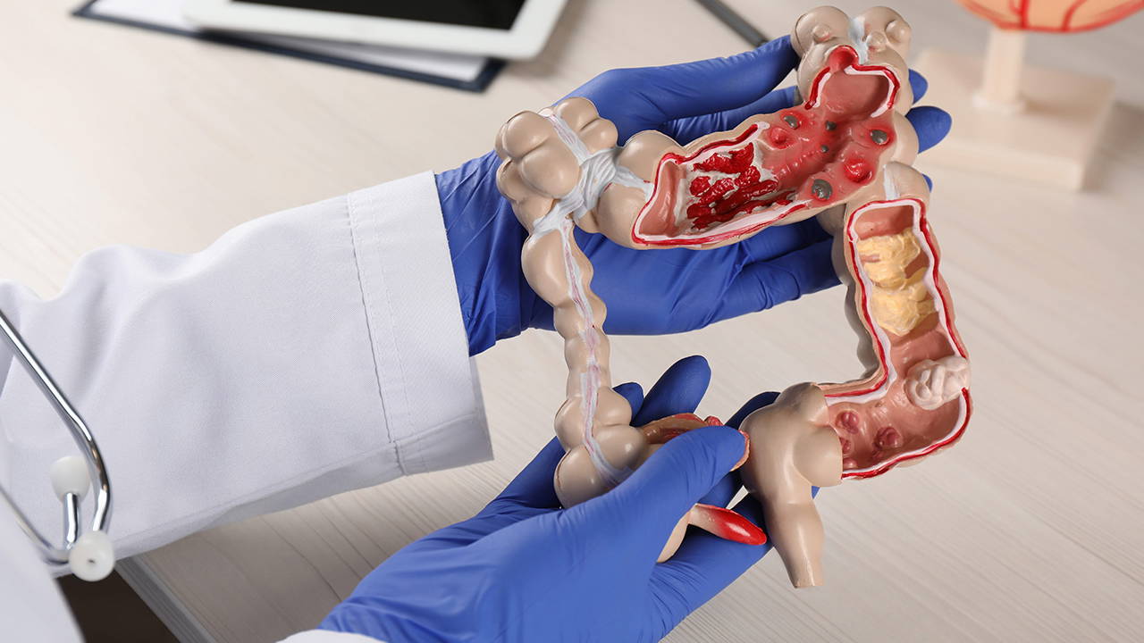 Genetik mirasınız sizi risk altına sokabilir: Kolon kanserinde 40 yaş uyarısı!