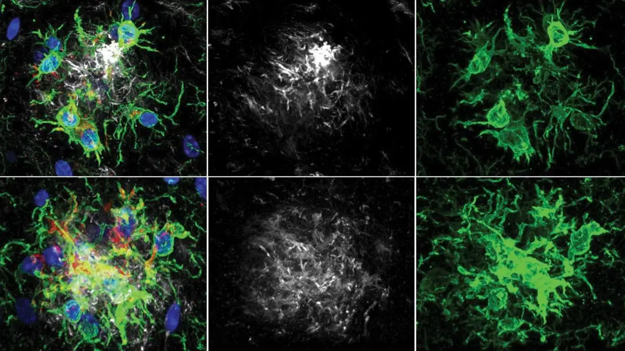Alzheimer tedavisinde yeni ufuk: Beynin 'temizlik ekibi' yeniden programlandı